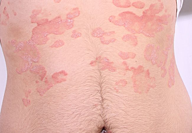 La psoriasis sobre la cabeza los síntomas
