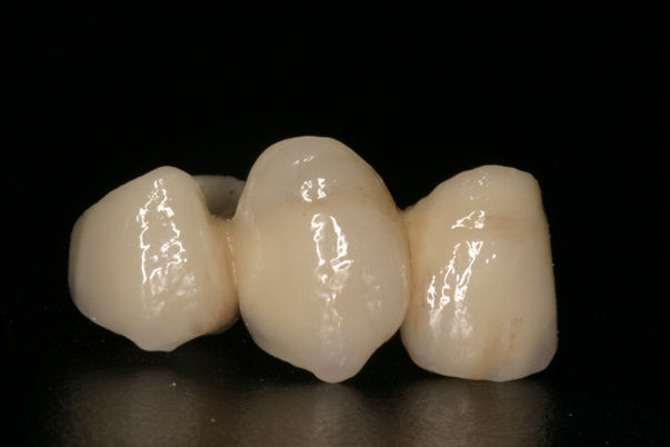 Prótesis fija: Especialidades de Clínica Dental Medicalia Fuenlabrada, tus dentistas de confianza Prótesis fija: Especialidades de Clínica Dental Medicalia Fuenlabrada, tus dentistas de confianza