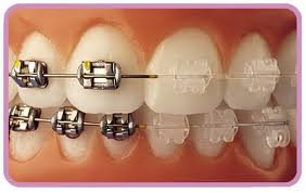 Ortodoncia clásica: Especialidades de Clínica Dental Medicalia Fuenlabrada, tus dentistas de confianza Ortodoncia clásica: Especialidades de Clínica Dental Medicalia Fuenlabrada, tus dentistas de confianza