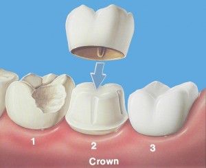 Coronas o Fundas: Especialidades de Clínica Dental Medicalia Fuenlabrada, tus dentistas de confianza Coronas o Fundas: Especialidades de Clínica Dental Medicalia Fuenlabrada, tus dentistas de confianza