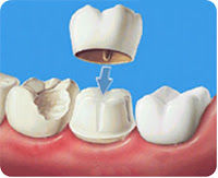 Coronas o Fundas: Especialidades de Clínica Dental Medicalia Fuenlabrada, tus dentistas de confianza Coronas o Fundas: Especialidades de Clínica Dental Medicalia Fuenlabrada, tus dentistas de confianza