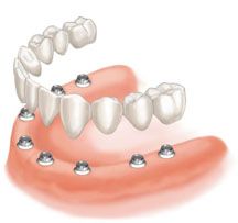 Protesis sobre implantes: Especialidades de Clínica Dental Medicalia Fuenlabrada, tus dentistas de confianza Protesis sobre implantes: Especialidades de Clínica Dental Medicalia Fuenlabrada, tus dentistas de confianza