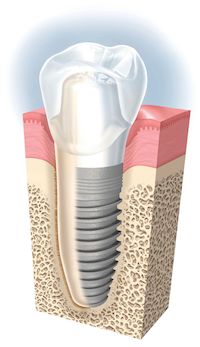 Implantes : Especialidades de Clínica Dental Medicalia Fuenlabrada, tus dentistas de confianza Implantes : Especialidades de Clínica Dental Medicalia Fuenlabrada, tus dentistas de confianza