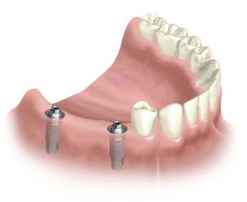 Implantes : Especialidades de Clínica Dental Medicalia Fuenlabrada, tus dentistas de confianza Implantes : Especialidades de Clínica Dental Medicalia Fuenlabrada, tus dentistas de confianza