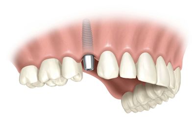 Implantes : Especialidades de Clínica Dental Medicalia Fuenlabrada, tus dentistas de confianza Implantes : Especialidades de Clínica Dental Medicalia Fuenlabrada, tus dentistas de confianza