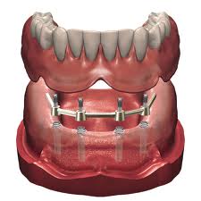 Protesis sobre implantes: Especialidades de Clínica Dental Medicalia Fuenlabrada, tus dentistas de confianza Protesis sobre implantes: Especialidades de Clínica Dental Medicalia Fuenlabrada, tus dentistas de confianza