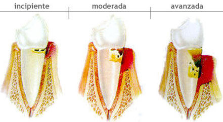 Periodoncia: Especialidades de Clínica Dental Medicalia Fuenlabrada, tus dentistas de confianza Periodoncia: Especialidades de Clínica Dental Medicalia Fuenlabrada, tus dentistas de confianza