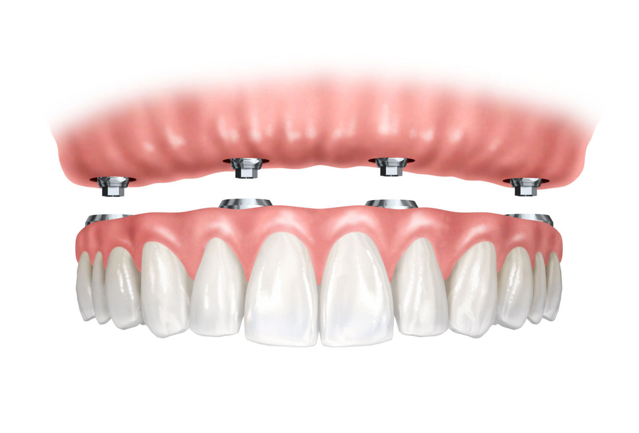 Prótesis removible: Especialidades de Clínica Dental Medicalia Fuenlabrada, tus dentistas de confianza Prótesis removible: Especialidades de Clínica Dental Medicalia Fuenlabrada, tus dentistas de confianza