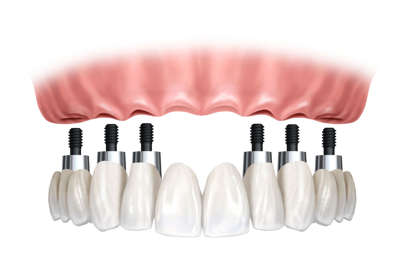 Prótesis removible: Especialidades de Clínica Dental Medicalia Fuenlabrada, tus dentistas de confianza Prótesis removible: Especialidades de Clínica Dental Medicalia Fuenlabrada, tus dentistas de confianza