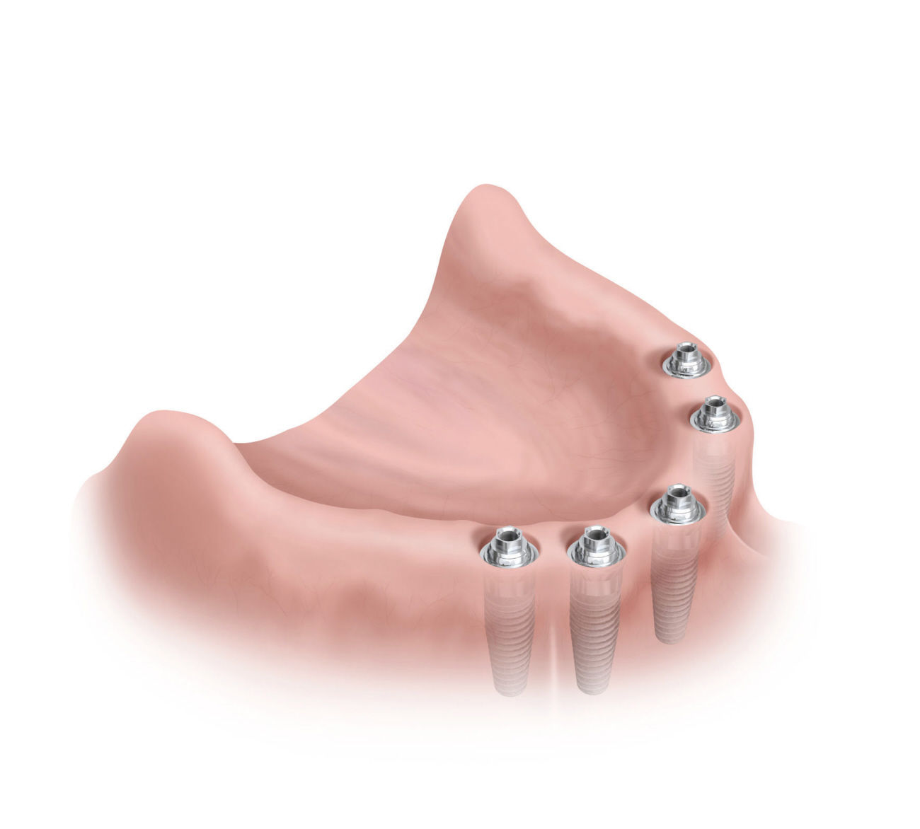 Protesis sobre implantes: Especialidades de Clínica Dental Medicalia Fuenlabrada, tus dentistas de confianza Protesis sobre implantes: Especialidades de Clínica Dental Medicalia Fuenlabrada, tus dentistas de confianza