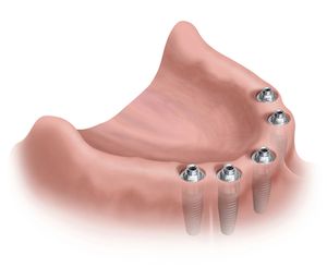 Protesis sobre implantes: Especialidades de Clínica Dental Medicalia Fuenlabrada, tus dentistas de confianza Protesis sobre implantes: Especialidades de Clínica Dental Medicalia Fuenlabrada, tus dentistas de confianza