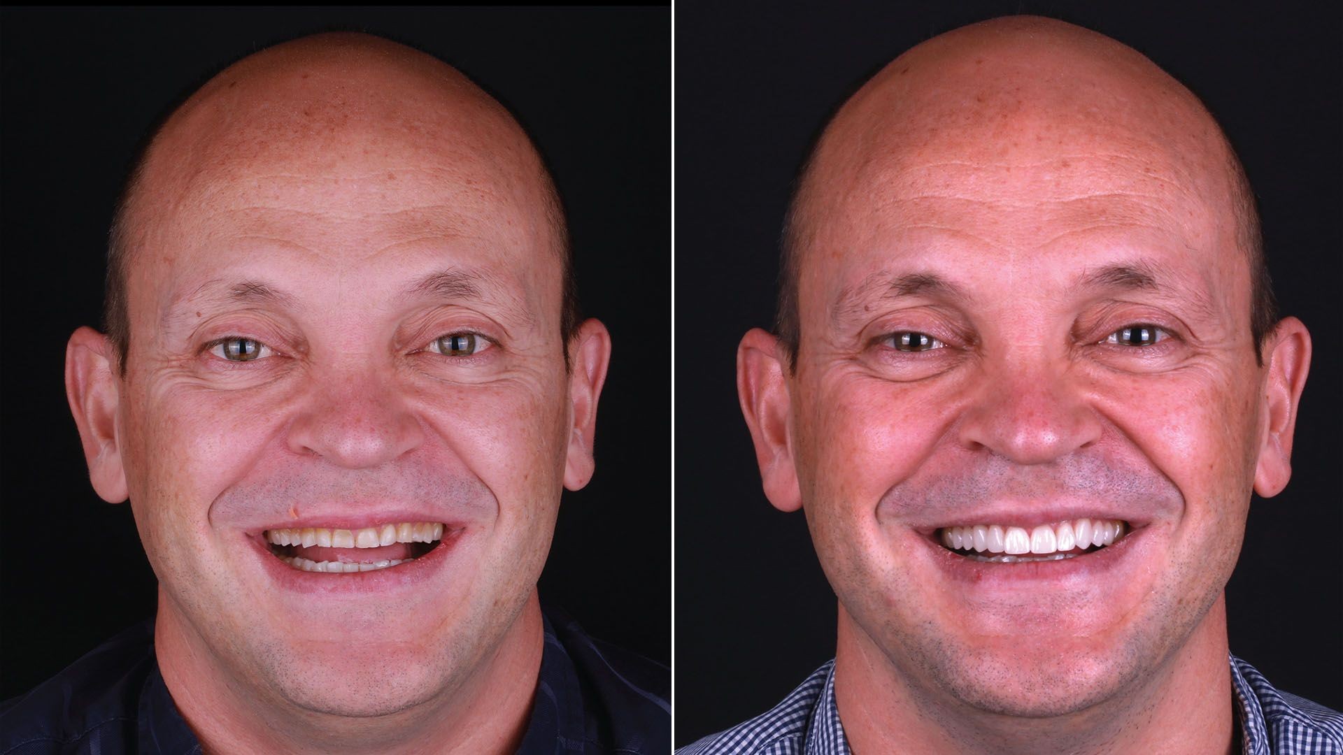 Antes y Despues - Daniel Antes y Despues - Daniel