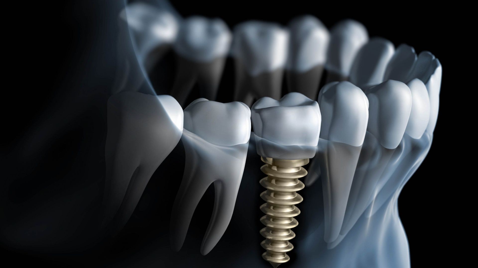 implantes dentales implantes dentales