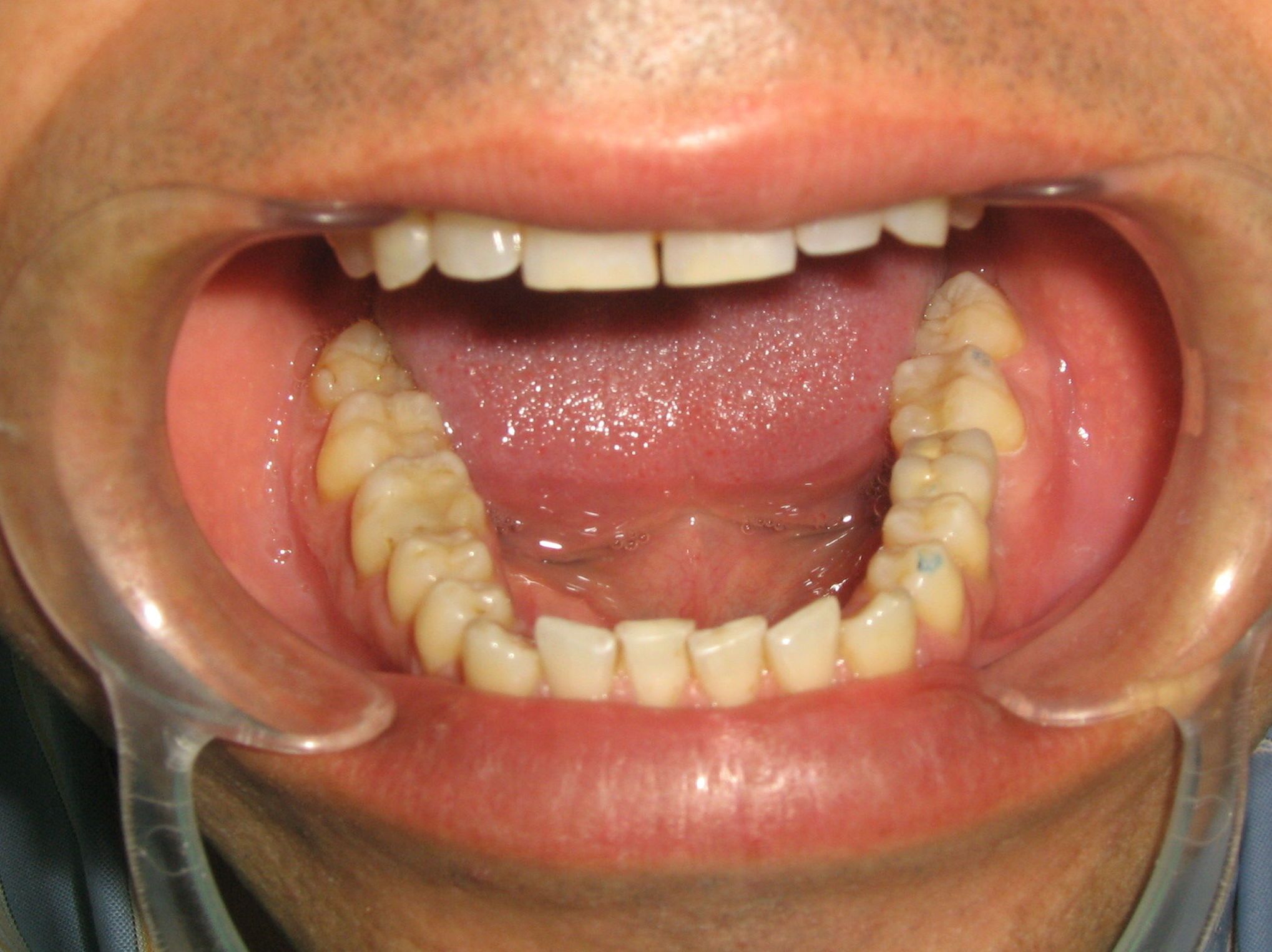 Corona sobre implante de molar inferior Corona sobre implante de molar inferior