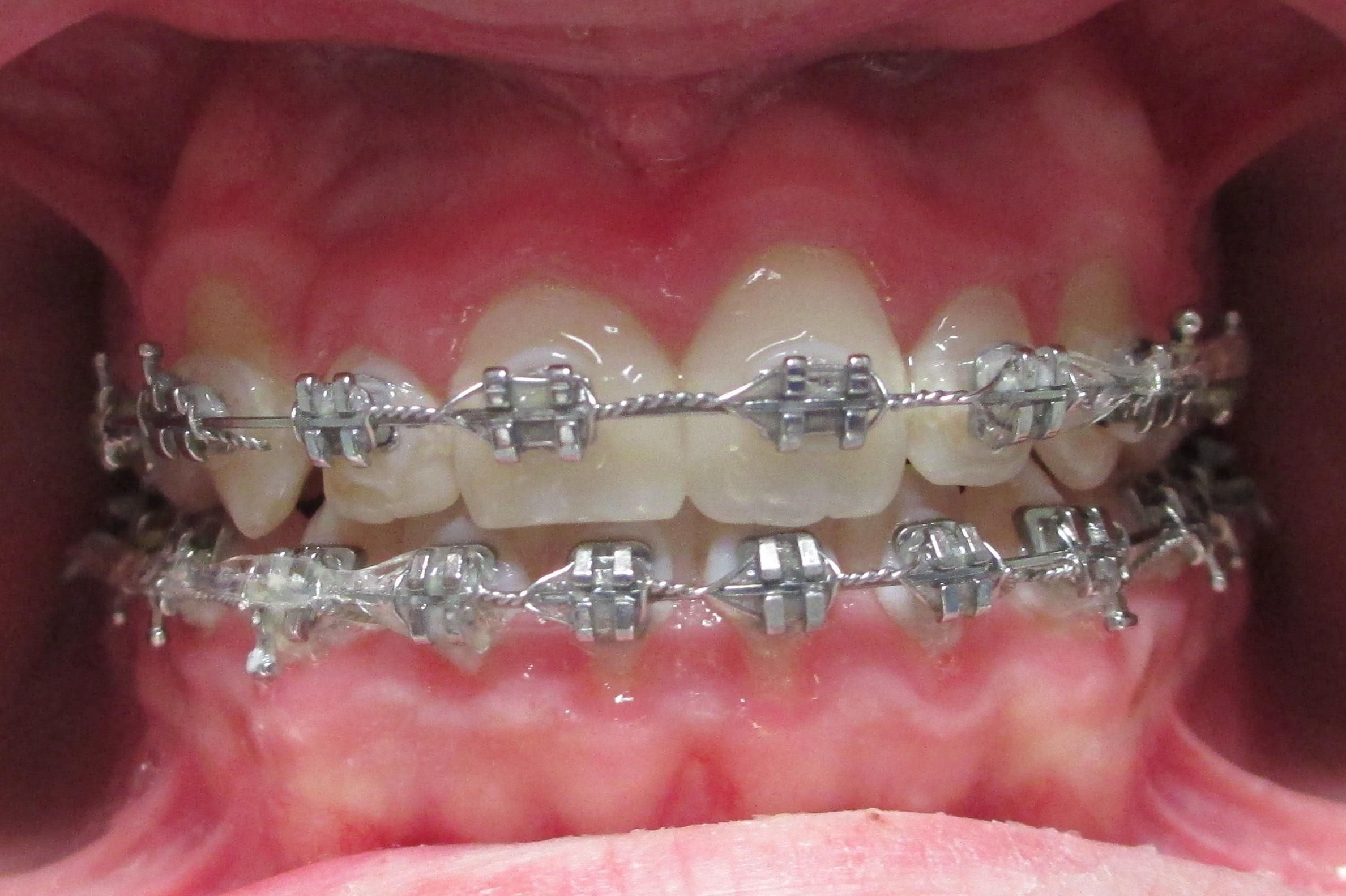 Ortodoncia: Tratamientos de Clinica Dental Elisa Ravojc Ortodoncia: Tratamientos de Clinica Dental Elisa Ravojc