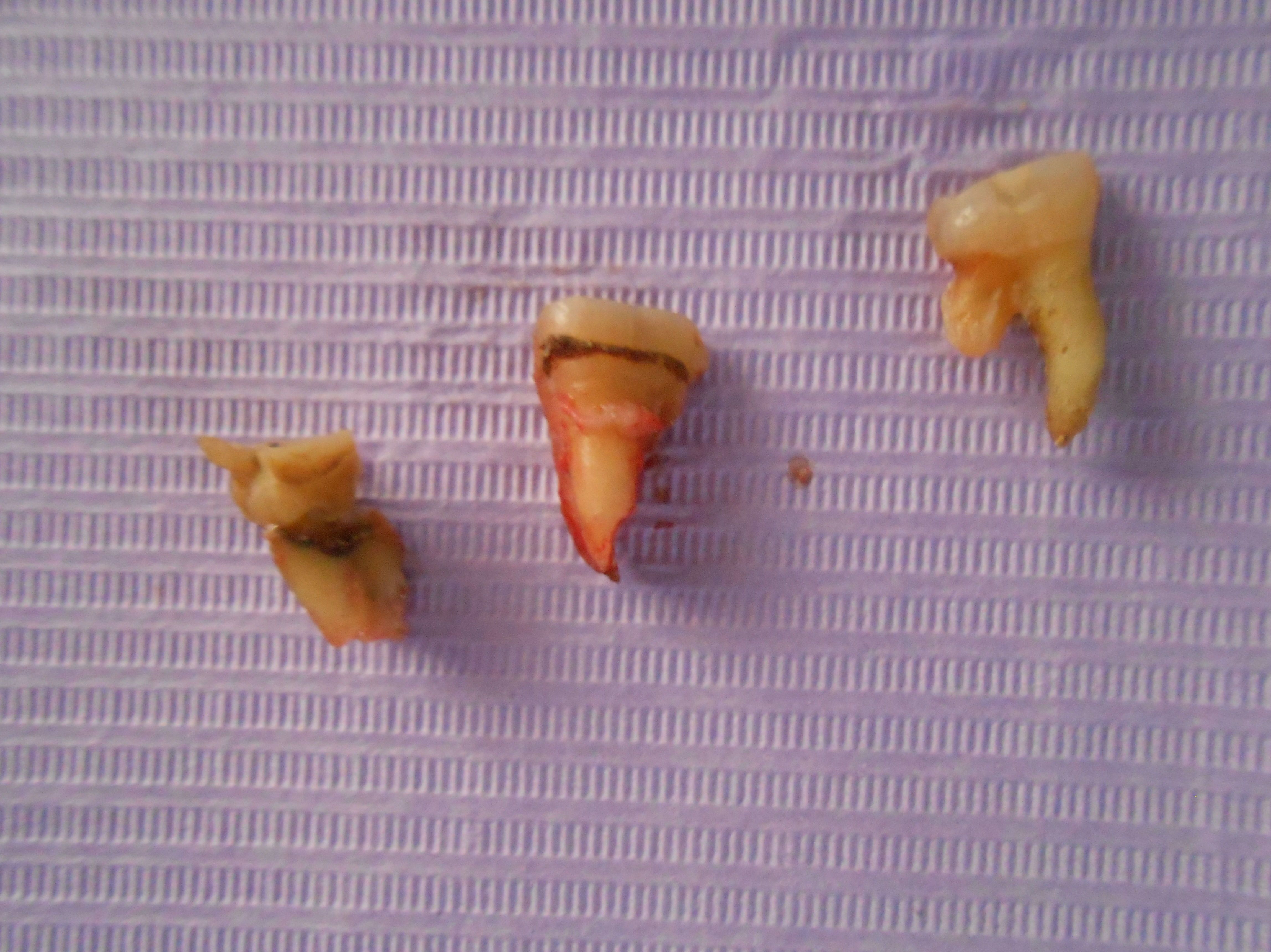 Primer molar fracturado Primer molar fracturado