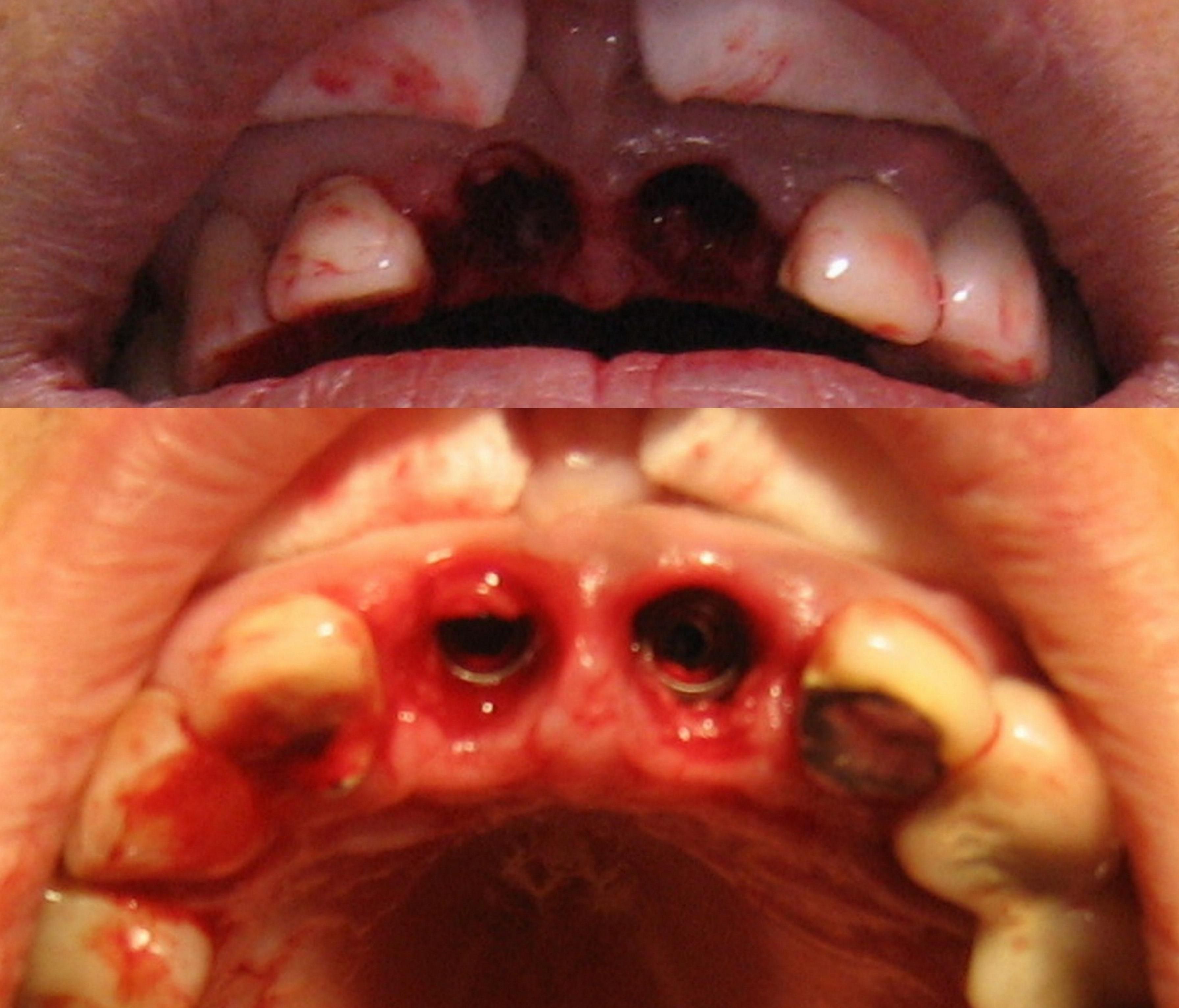 Extracción de las piezas delanteras y colocado de implantes Extracción de las piezas delanteras y colocado de implantes