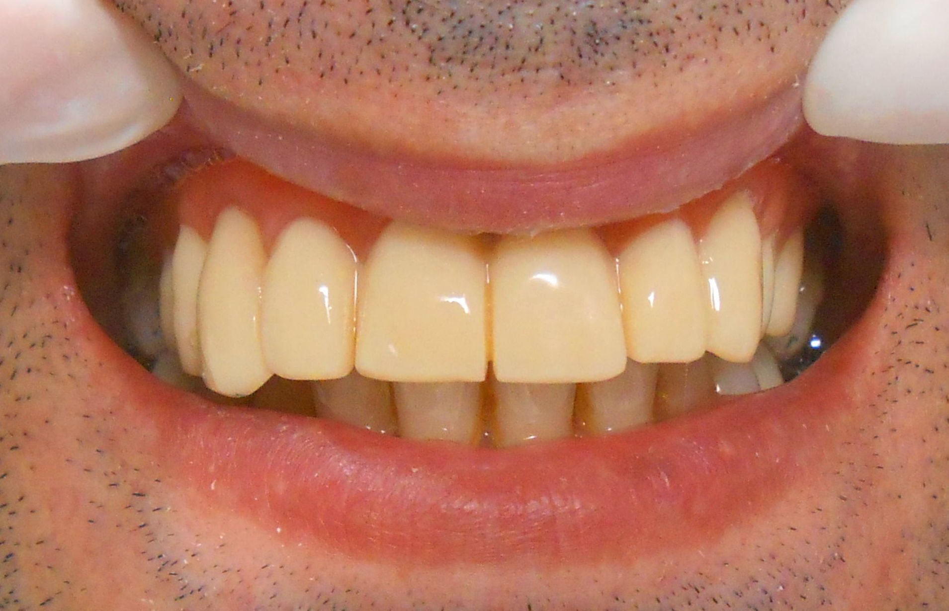 Rehabilitación Superior con implantes de carga inmediata Rehabilitación Superior con implantes de carga inmediata