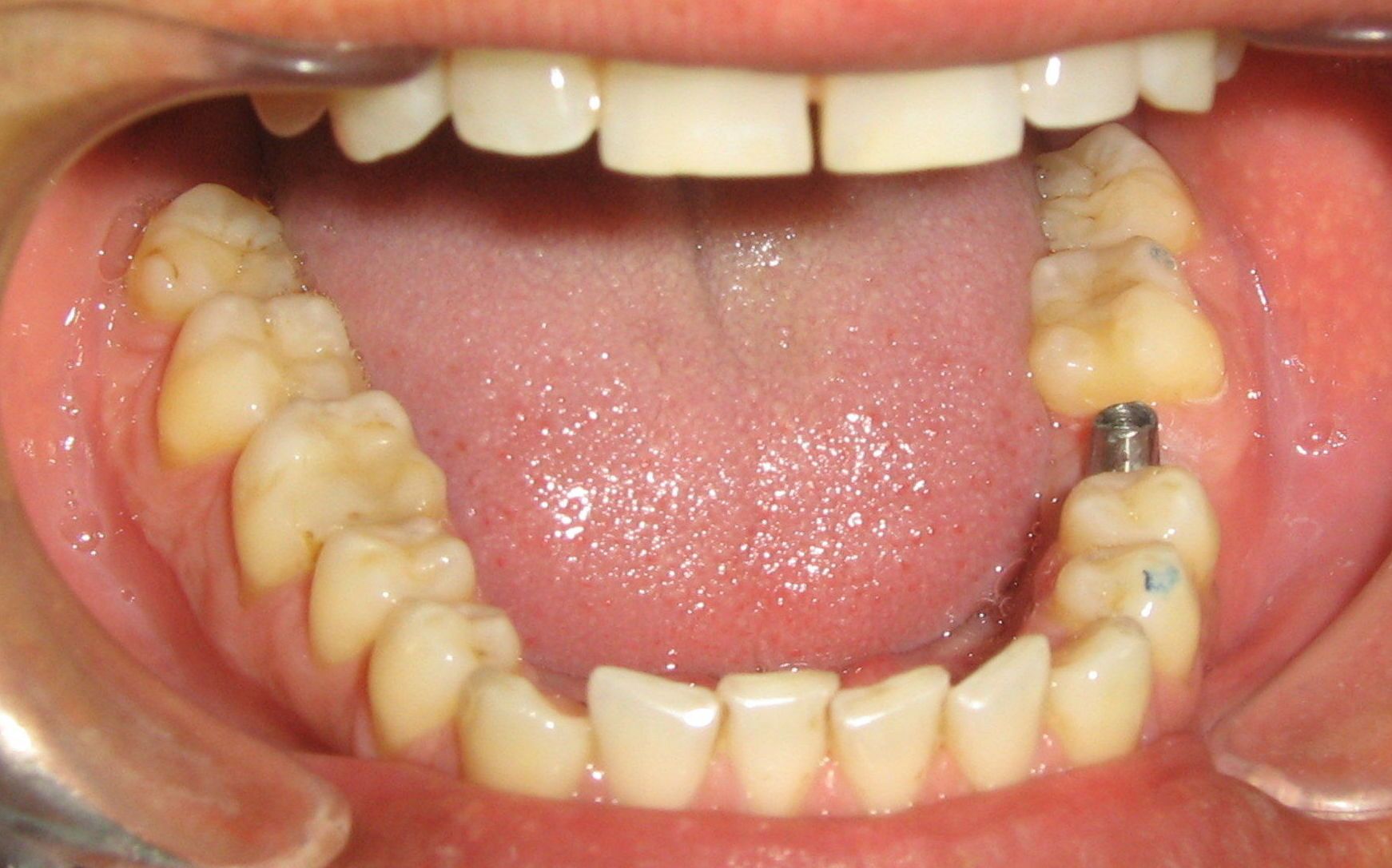 Implante unitario de molar inferior Implante unitario de molar inferior