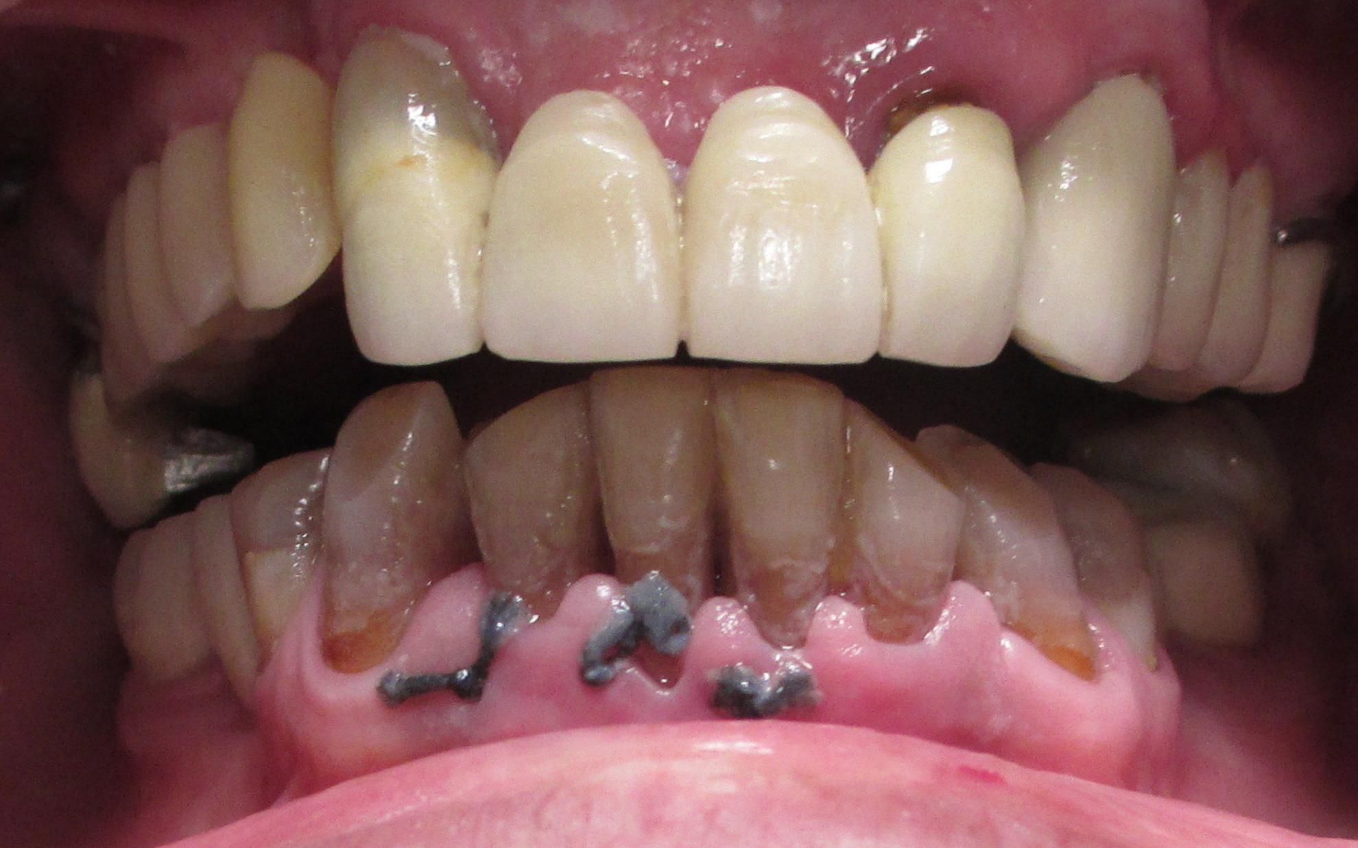 Tratamiento periodontal Tratamiento periodontal