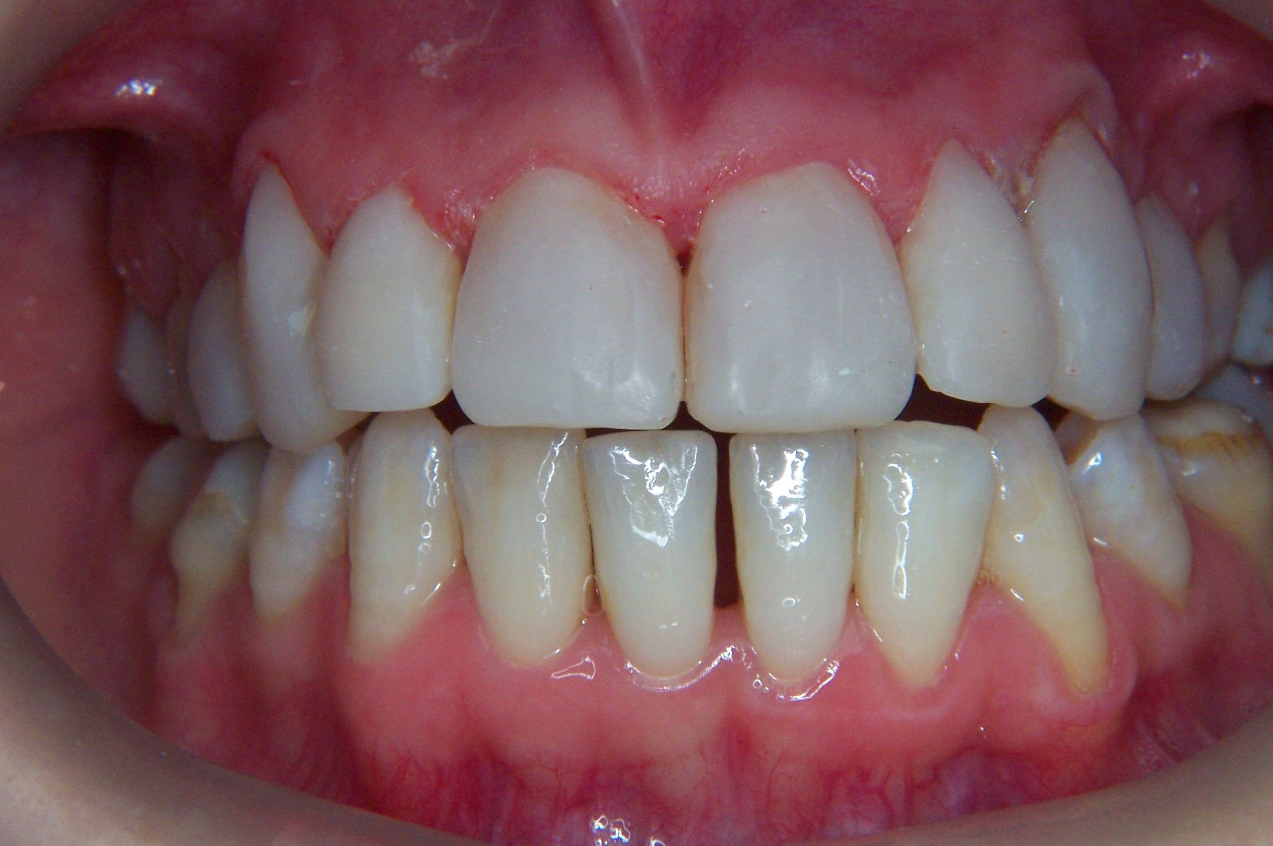 ESTETICA DENTAL, CARILLAS DIRECTAS DE COMPOSITE: Tratamientos de Clínica Dental Francisco Javier García Jerónimo ESTETICA DENTAL, CARILLAS DIRECTAS DE COMPOSITE: Tratamientos de Clínica Dental Francisco Javier García Jerónimo