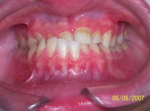 Ortodoncia adolescentes: Tratamientos de Clínica Dental Francisco Javier García Jerónimo Ortodoncia adolescentes: Tratamientos de Clínica Dental Francisco Javier García Jerónimo