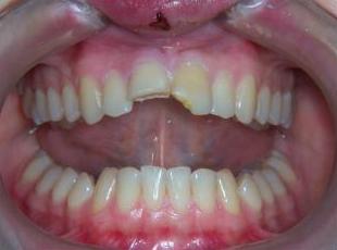 DR GARCIA JERONIMO MOTRIL. CORONAS DE ALTA ESTETICA TOTALMENTE CERAMICAS DR GARCIA JERONIMO MOTRIL. CORONAS DE ALTA ESTETICA TOTALMENTE CERAMICAS