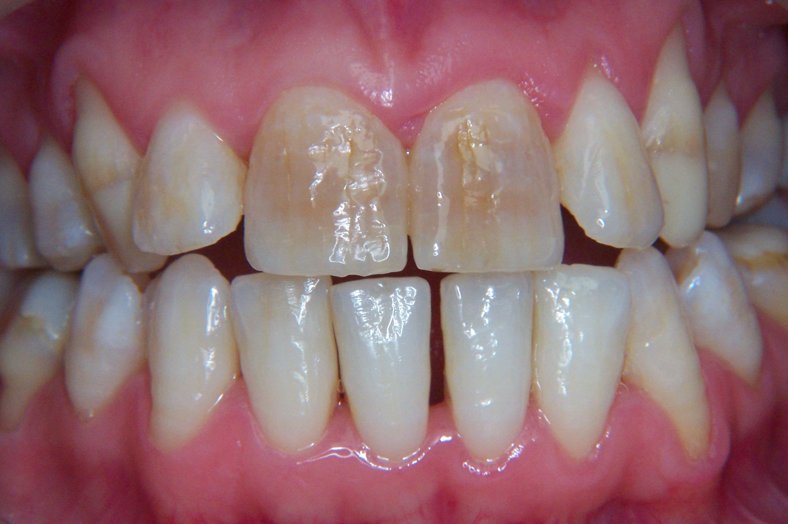 ESTETICA DENTAL, CARILLAS DIRECTAS DE COMPOSITE: Tratamientos de Clínica Dental Francisco Javier García Jerónimo ESTETICA DENTAL, CARILLAS DIRECTAS DE COMPOSITE: Tratamientos de Clínica Dental Francisco Javier García Jerónimo