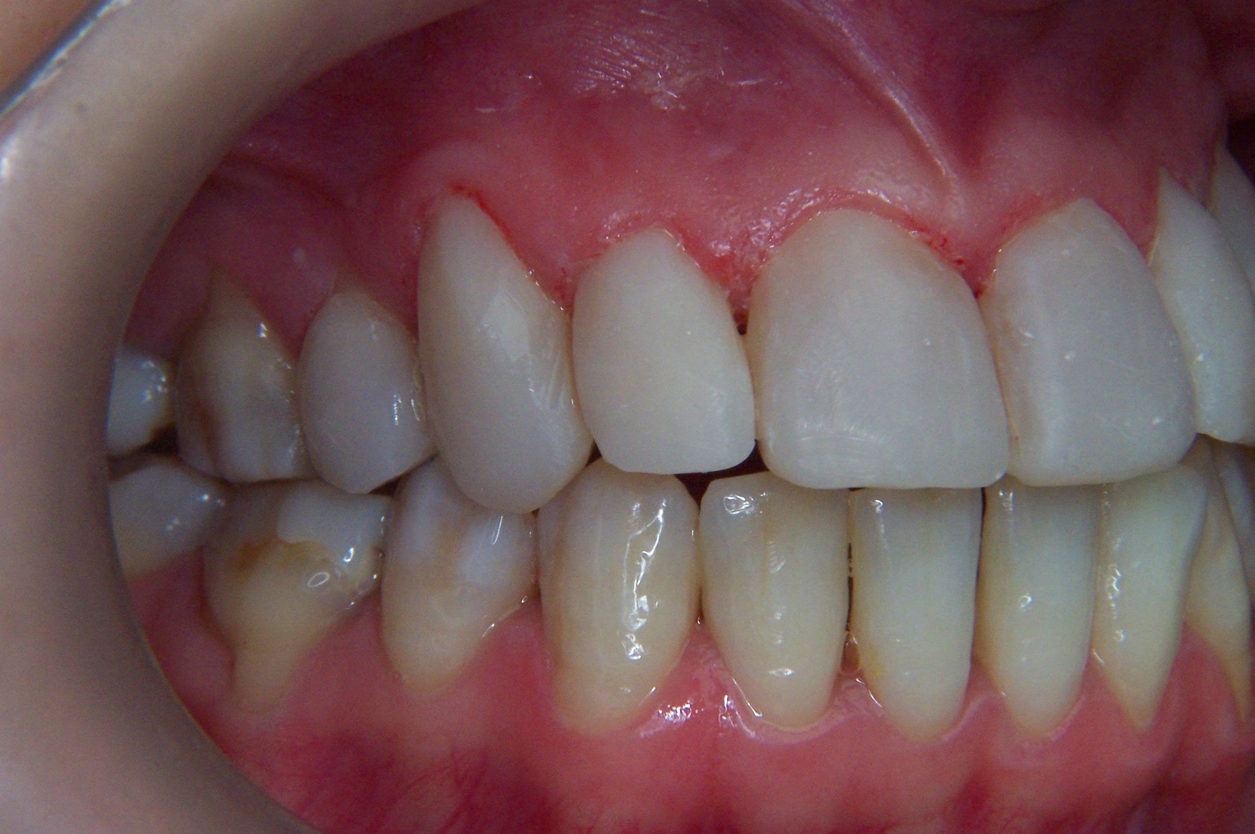 ESTETICA DENTAL, CARILLAS DIRECTAS DE COMPOSITE: Tratamientos de Clínica Dental Francisco Javier García Jerónimo ESTETICA DENTAL, CARILLAS DIRECTAS DE COMPOSITE: Tratamientos de Clínica Dental Francisco Javier García Jerónimo