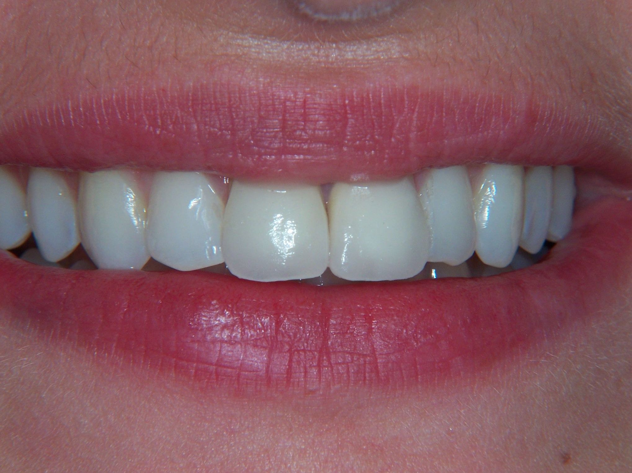 DR GARCIA JERONIMO MOTRIL CORONA ALTA ESTETICA POST FRACTURA DENTAL DR GARCIA JERONIMO MOTRIL CORONA ALTA ESTETICA POST FRACTURA DENTAL