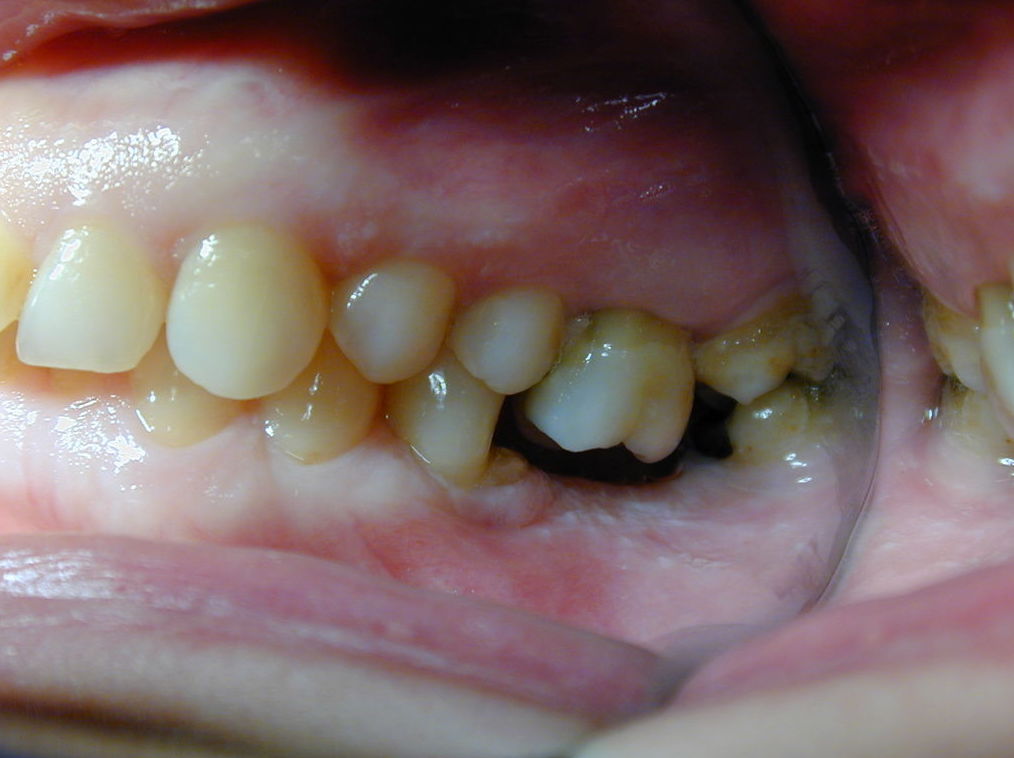DR GARCIA JERONIMO PERDIDA DE ESPACIO OCLUSAL, REHABILITACION IMPLANTOLOGICA DR GARCIA JERONIMO PERDIDA DE ESPACIO OCLUSAL, REHABILITACION IMPLANTOLOGICA