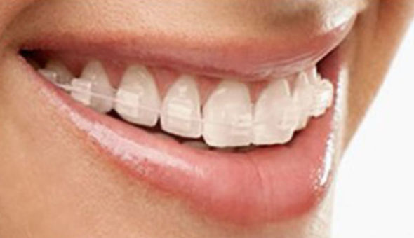 Brackets Zafiro: Tratamientos Dentales de Clínica Dental Getafe Brackets Zafiro: Tratamientos Dentales de Clínica Dental Getafe