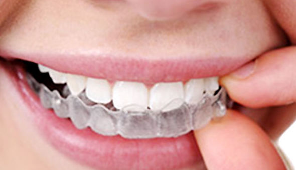 Invisalign: Tratamientos Dentales de Clínica Dental Getafe Invisalign: Tratamientos Dentales de Clínica Dental Getafe