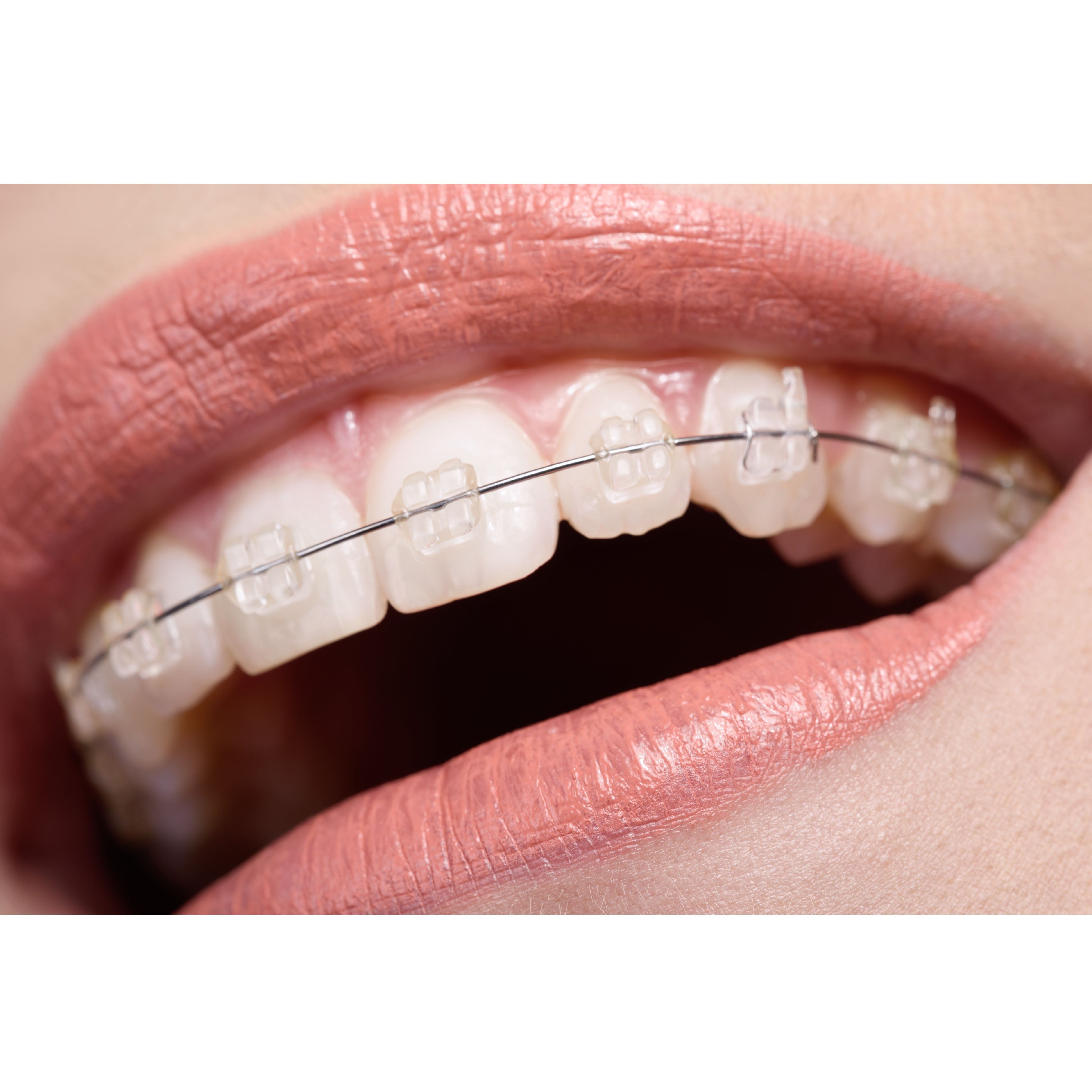 Tipos de ortodoncia: Tratamientos Dentales de Clínica Dental Getafe Tipos de ortodoncia: Tratamientos Dentales de Clínica Dental Getafe
