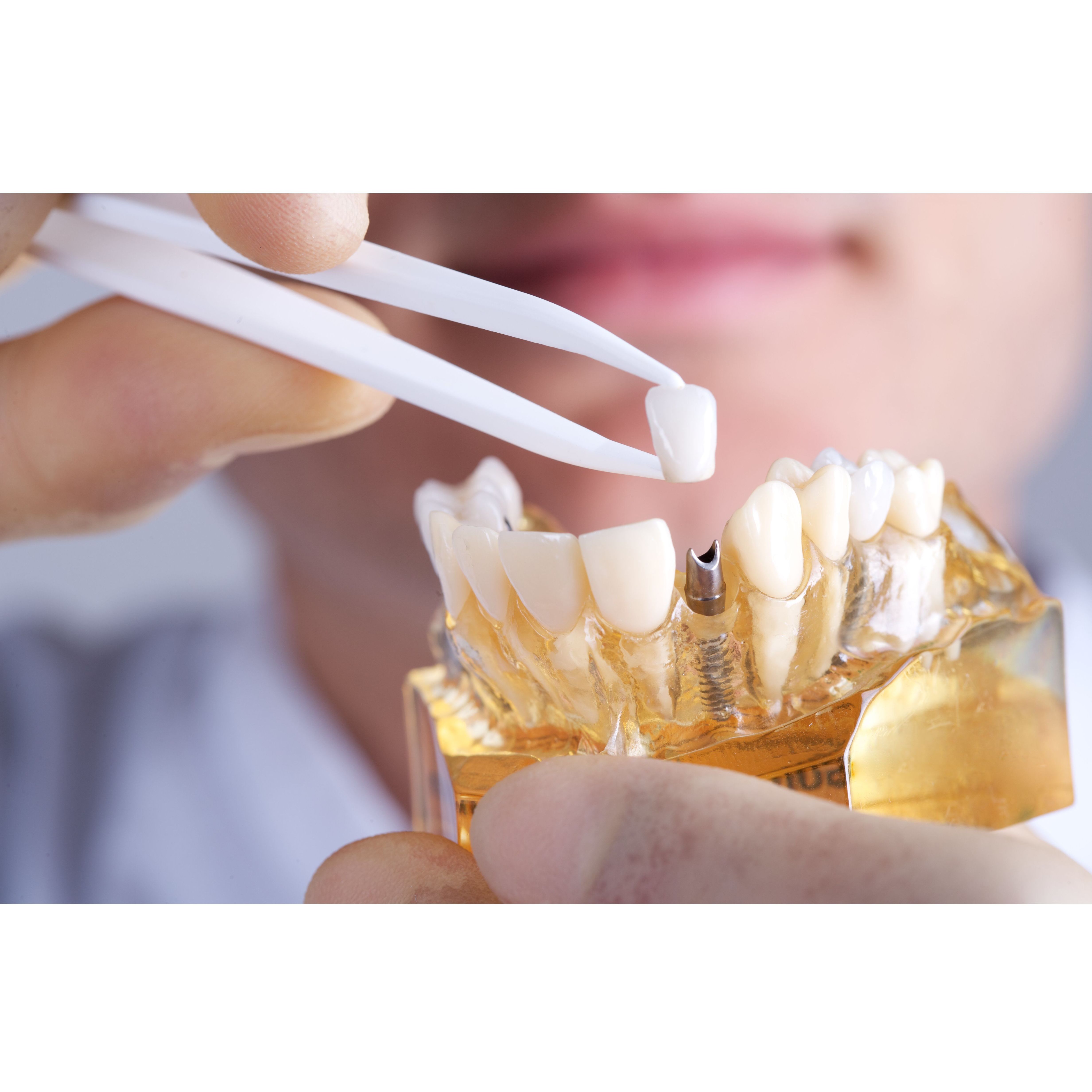 Implantes dentales: Tratamientos Dentales de Clínica Dental Getafe Implantes dentales: Tratamientos Dentales de Clínica Dental Getafe