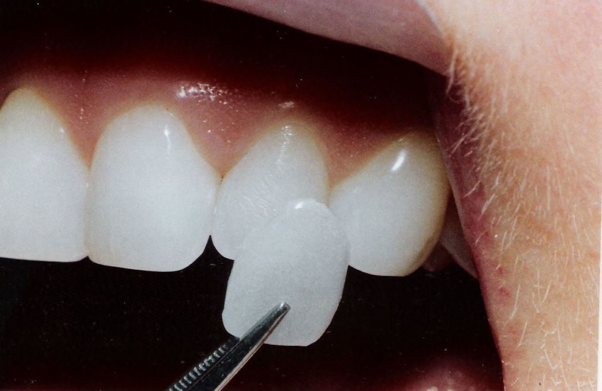 Carillas dentales Getafe Carillas dentales Getafe