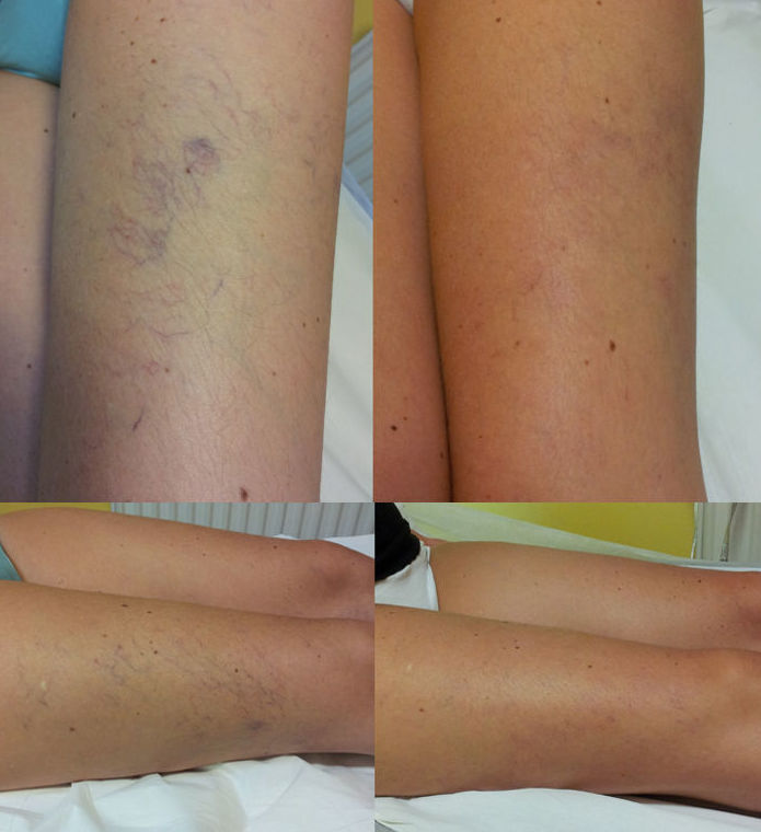 Varices: Tratamientos de Centro Médico Bellón Varices: Tratamientos de Centro Médico Bellón