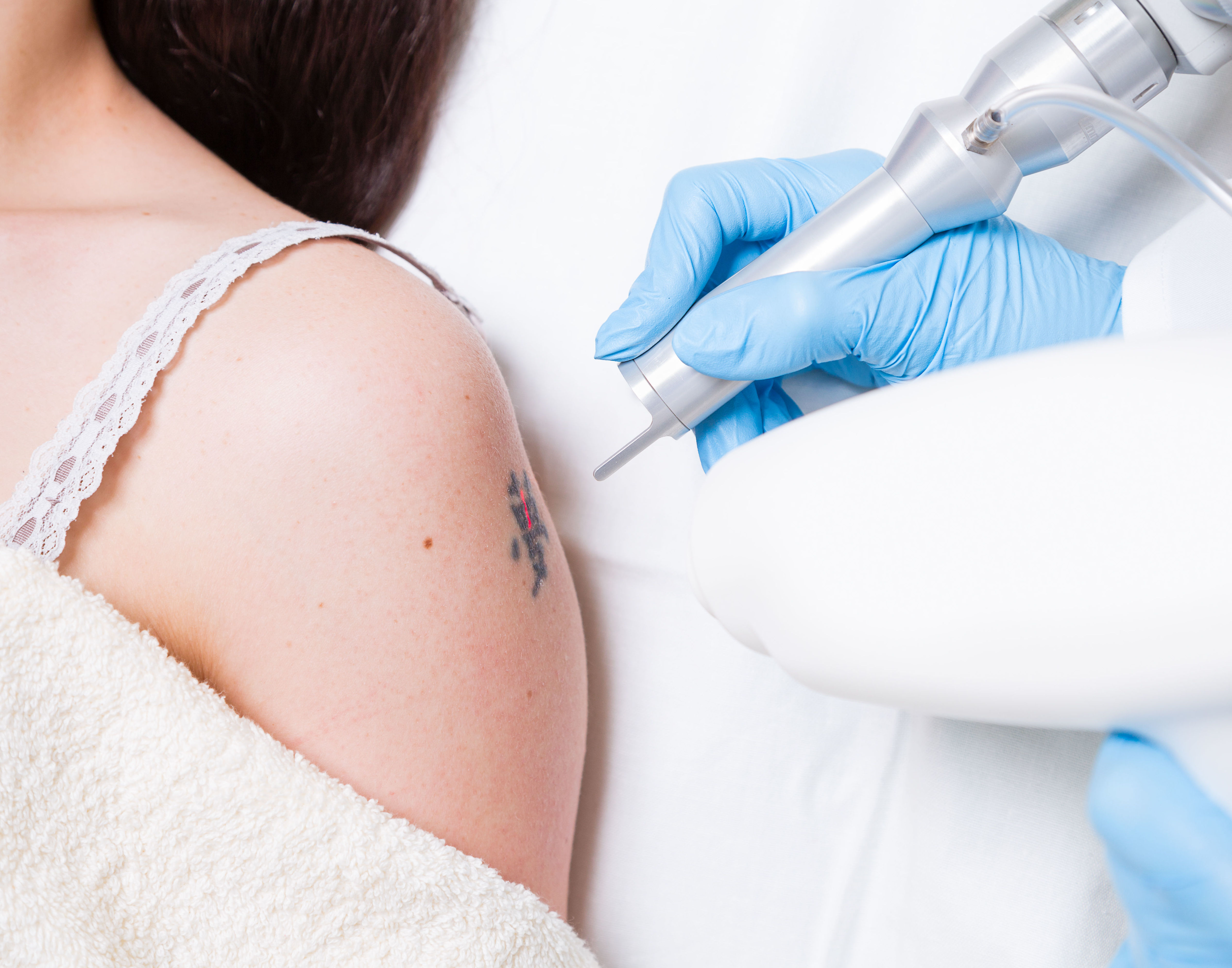 Eliminación de tatuajes y manchas: Tratamientos de Centro Médico Bellón Eliminación de tatuajes y manchas: Tratamientos de Centro Médico Bellón