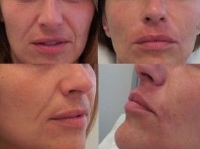 Relleno facial Relleno facial