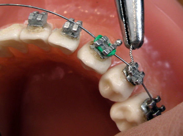 Ortodoncia: Tratamientos de Clínica Dental Doctor Chela Ortodoncia: Tratamientos de Clínica Dental Doctor Chela