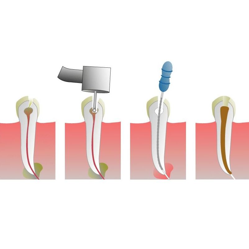 Endodoncia: Tratamientos de Clínica Dental Doctor Chela Endodoncia: Tratamientos de Clínica Dental Doctor Chela