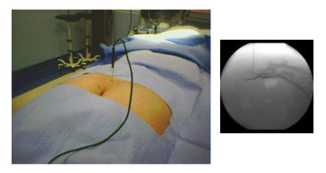 Radiofrecuencia de Nervios y Ganglios: Tratamientos de Asturias Dolor-Clínica Asturias Radiofrecuencia de Nervios y Ganglios: Tratamientos de Asturias Dolor-Clínica Asturias