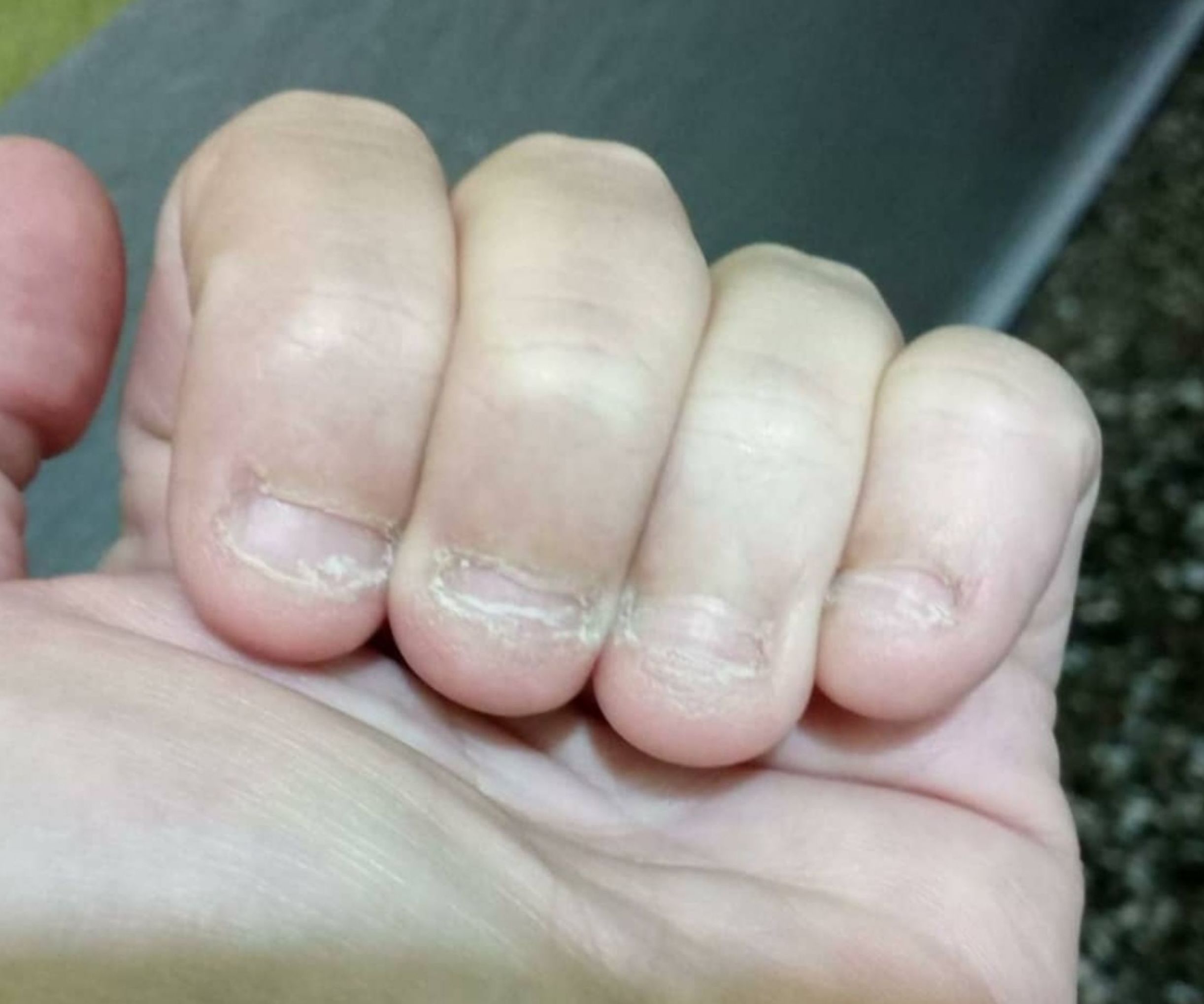 Ejemplo de uñas onicofagia Ejemplo de uñas onicofagia