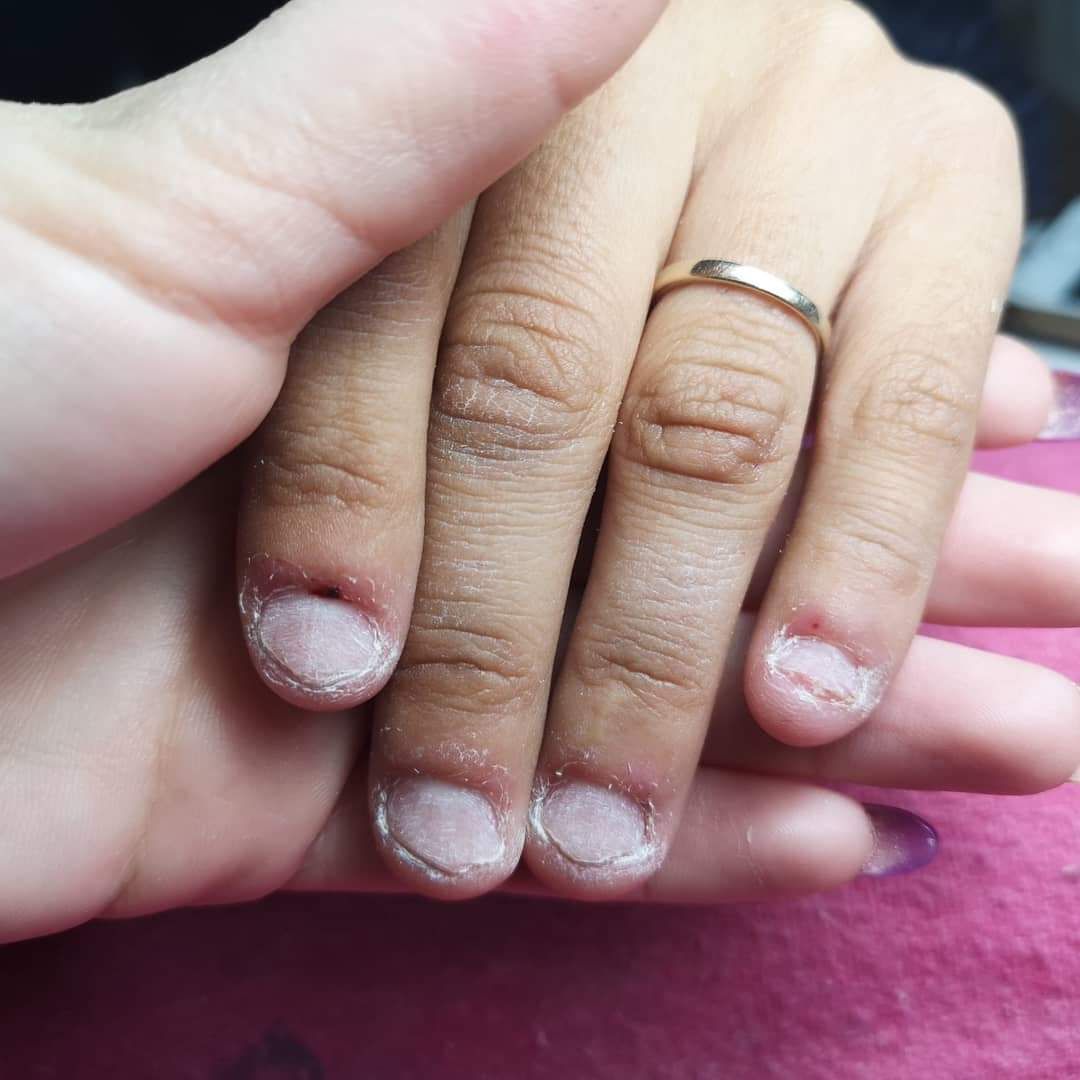 Reconstrucción de uñas mordidas: Servicios de Cristina Nails Reconstrucción de uñas mordidas: Servicios de Cristina Nails