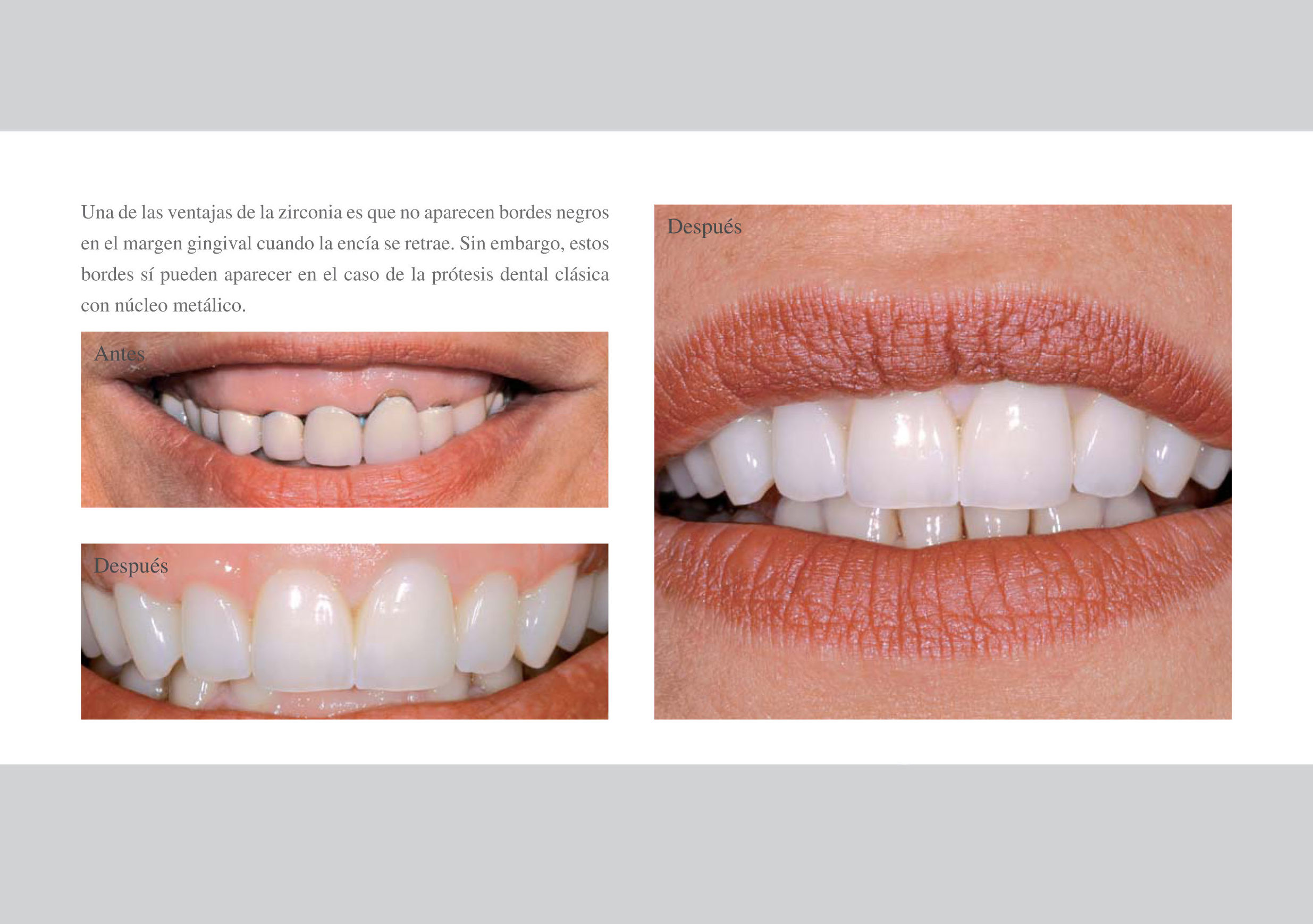 CORONAS DE ZIRCONIO: Tratamientos de Clínica Dental Ángel Artiz CORONAS DE ZIRCONIO: Tratamientos de Clínica Dental Ángel Artiz