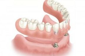 IMPLANTES SIN CIRUGÍA : Tratamientos de Clínica Dental Ángel Artiz IMPLANTES SIN CIRUGÍA : Tratamientos de Clínica Dental Ángel Artiz