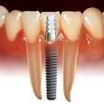IMPLANTES CON CIRUGÍA: Tratamientos de Clínica Dental Ángel Artiz IMPLANTES CON CIRUGÍA: Tratamientos de Clínica Dental Ángel Artiz