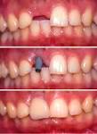 IMPLANTES CON CIRUGÍA: Tratamientos de Clínica Dental Ángel Artiz IMPLANTES CON CIRUGÍA: Tratamientos de Clínica Dental Ángel Artiz