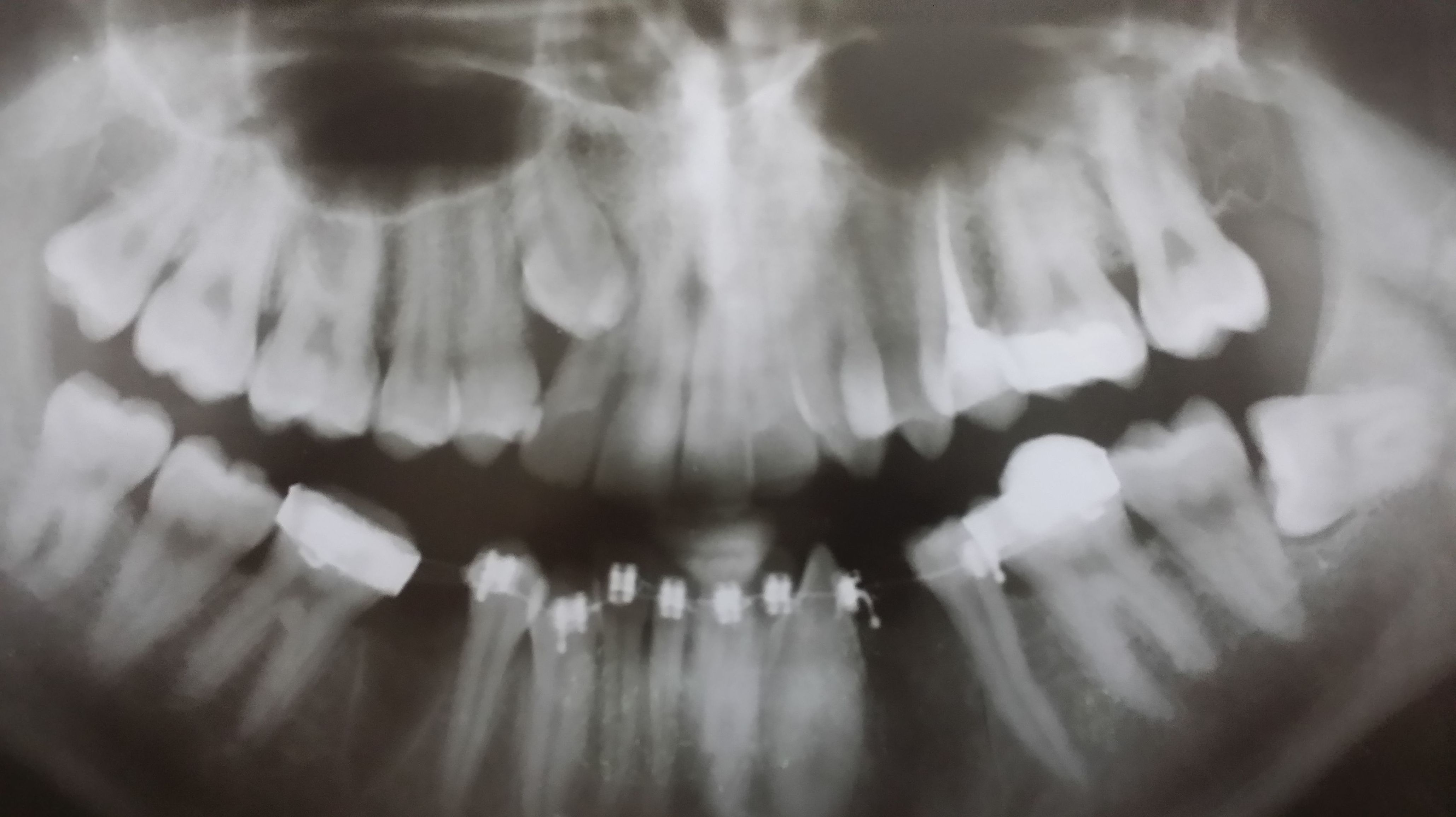 ORTODONCIA DE CANINOS INCLUÍDOS: Tratamientos de Clínica Dental Ángel Artiz ORTODONCIA DE CANINOS INCLUÍDOS: Tratamientos de Clínica Dental Ángel Artiz