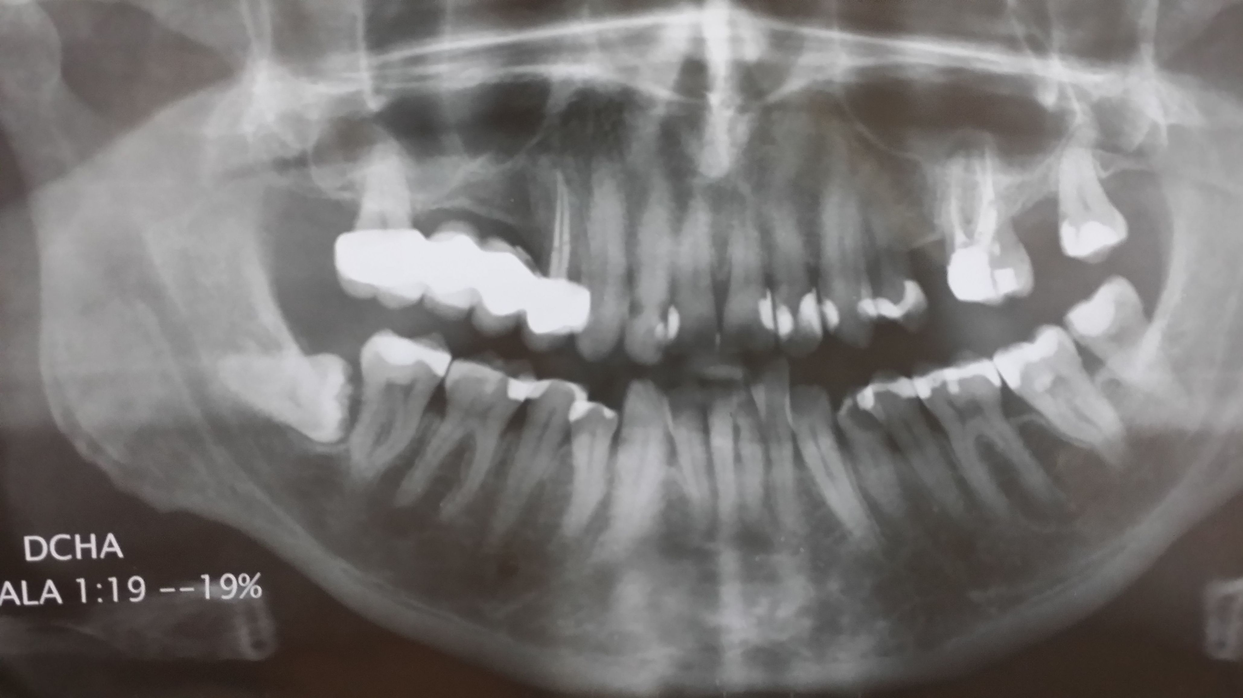 EXTRACCIÓN DE CORDALES O MUELAS DEL JUICIO: Tratamientos de Clínica Dental Ángel Artiz EXTRACCIÓN DE CORDALES O MUELAS DEL JUICIO: Tratamientos de Clínica Dental Ángel Artiz